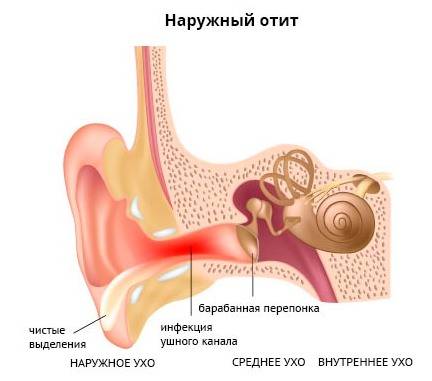 Наружный отит - лечение уха, симптомы у взрослых внешнего, как лечить острое воспаление слухового прохода в домашних условиях, признаки