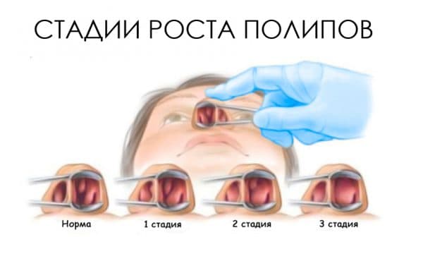 Лечение полипов в носу