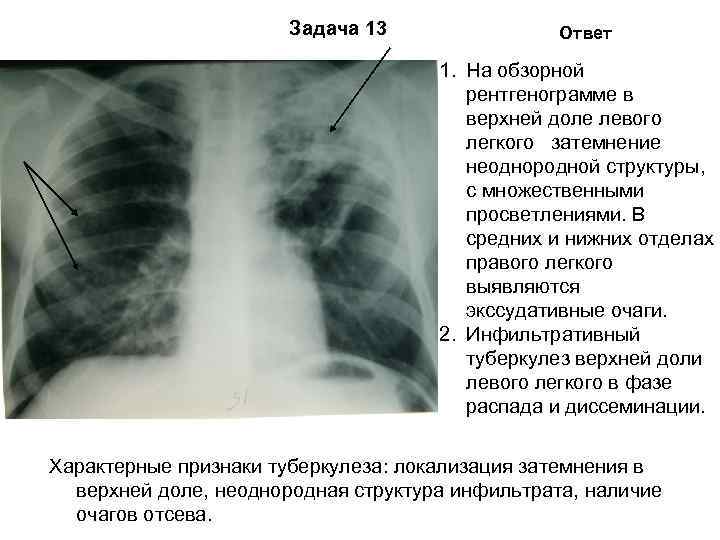 Очаговый туберкулез легких: заразен или нет, лечение и что это такое