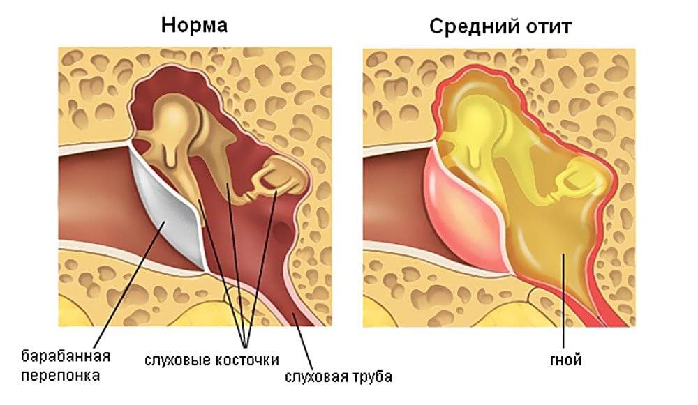 Экссудативный отит среднего уха у взрослых (серозный отит)
