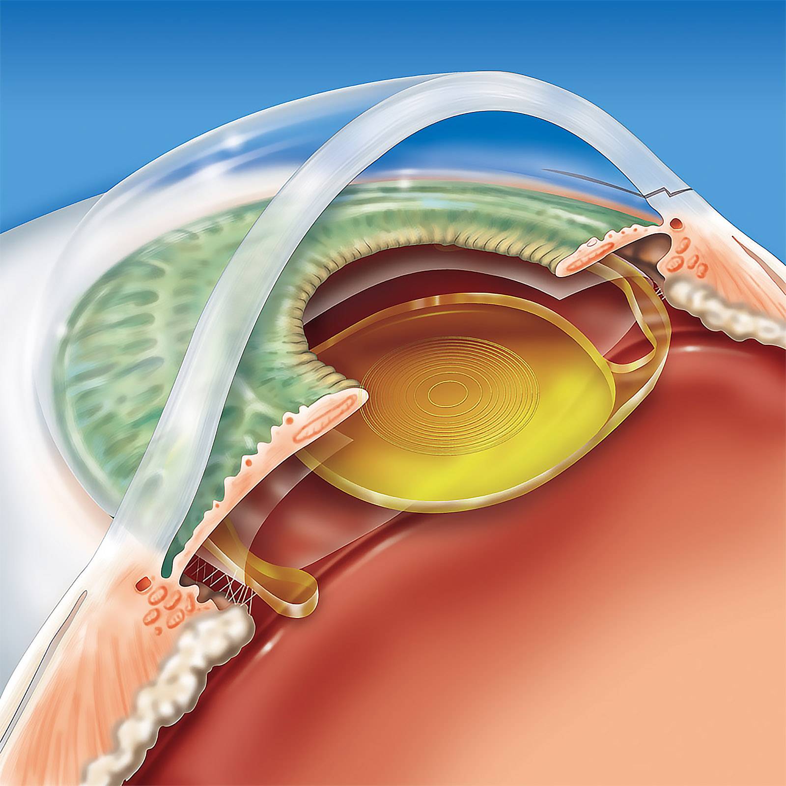 Диагноз катаракта? лечение без операции возможно?