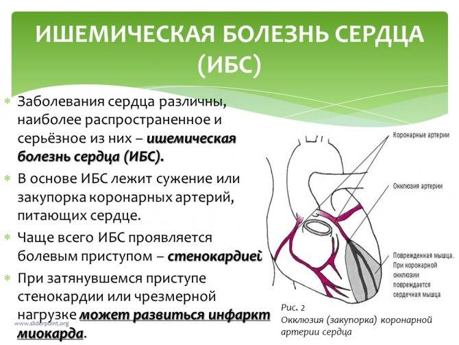 Ишемическая болезнь сердца: общие сведения | компетентно о здоровье на ilive