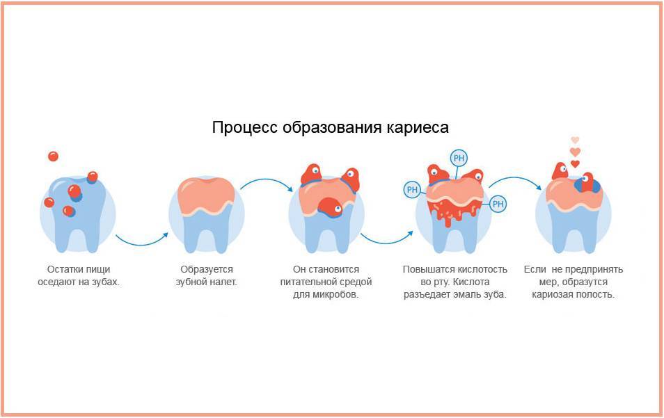 Этапы лечения кариеса зубов, описание алгоритма поэтапно