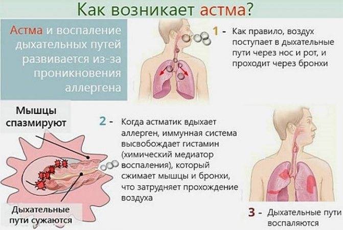 Купирование приступа бронхиальной астмы