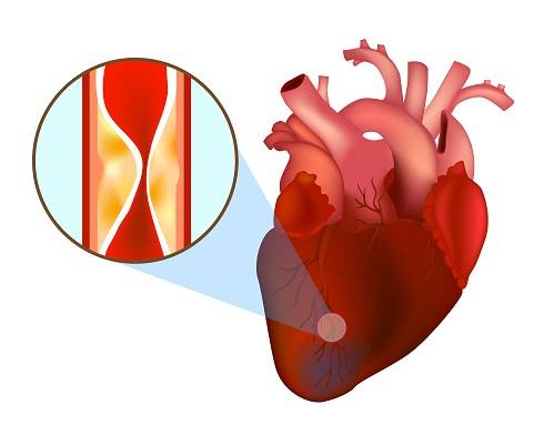 Стенокардия и инфаркт миокарда – причины заболеваний, которые встречаются каждый день или нет?