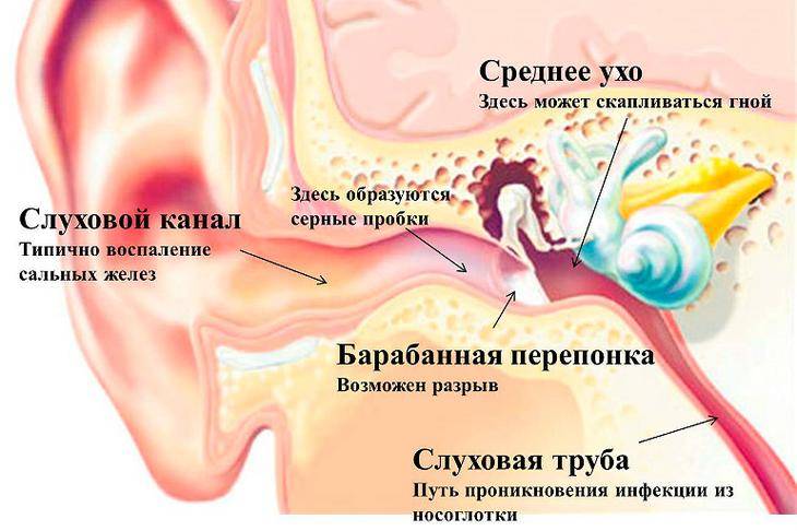 Пробки в ушах лечение в домашних условиях – ушная пробка — как избавиться от серной в ухе, симптомы и лечение в домашних условиях у взрослых, что делать, признаки, профилактика — toryal.ru