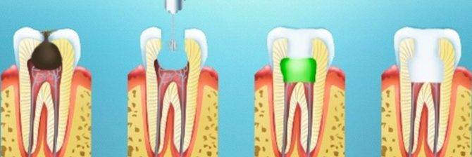 Боль вместо зубного нерва: о причинах,продолжительности и способах снятия неприятных ощущений после депульпирования зуба