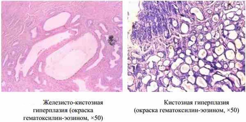 Железистая гиперплазия эндометрия