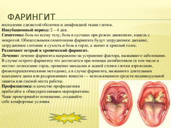 Катаральная ангина: причины, симптомы, лечение, профилактика