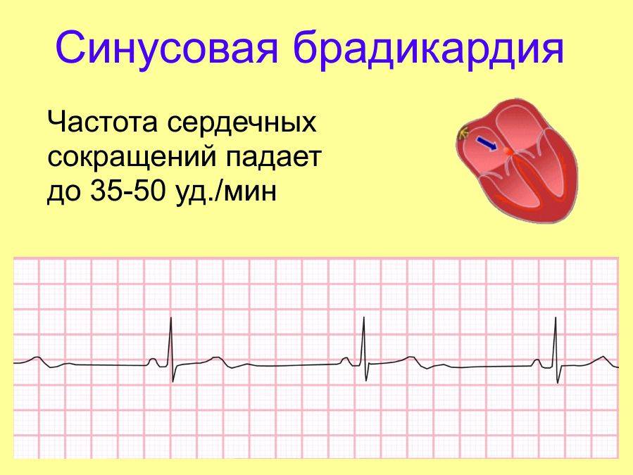 Что означает брадикардия в кардиограмме