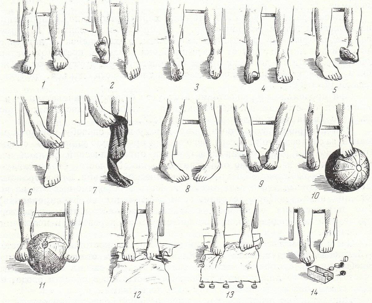 Упражнения при плоскостопии- комплекс лфк для ступней