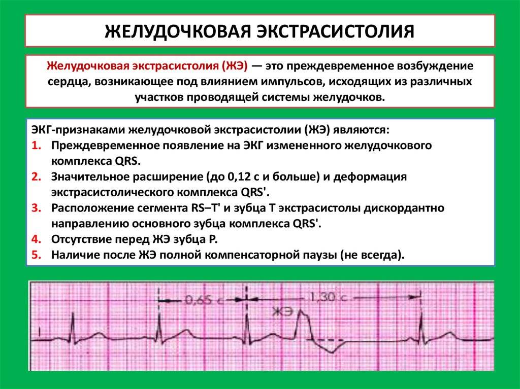Экстрасистолия сердца: опасно ли это, ответы кардиолога, что это такое, виды и лечение