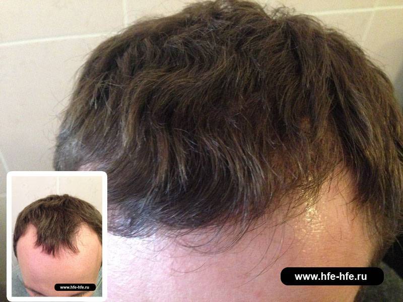 Алопеция — лечение, профилактика выпадения волос