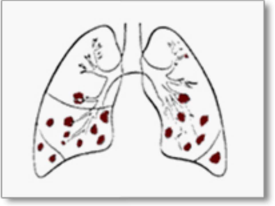 Застойная (гипостатическая) пневмония у лежачих – что это, ее код по мкб 10, какие прогнозы у пожилых больных, признаки и лечение, профилактика и факторы риска