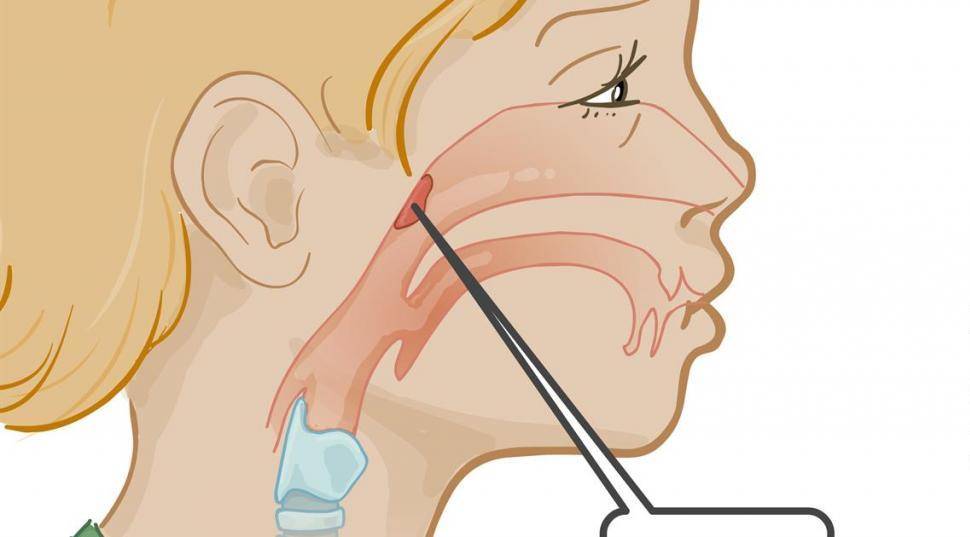 Массаж при аденоидах у детей, лазер в нос – как вылечить без операции