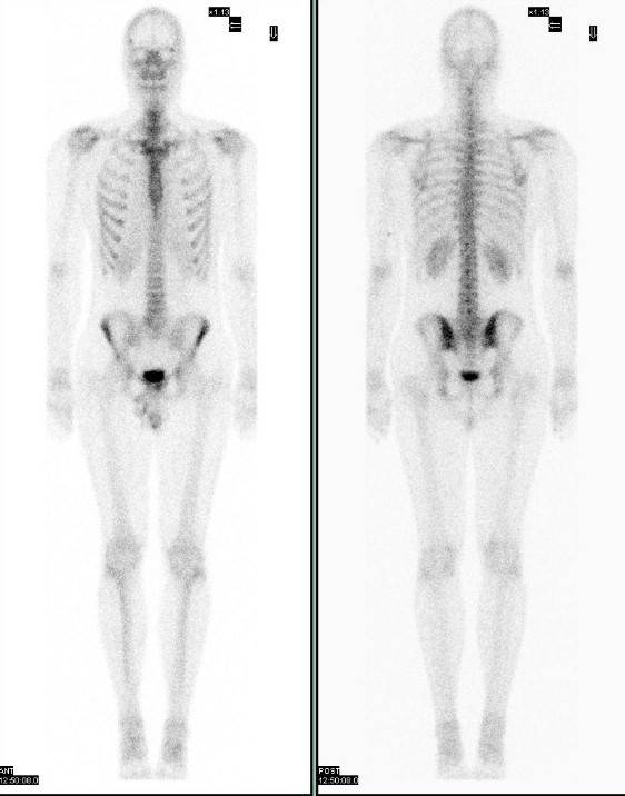 Сцинтиграфия костей скелета: как проводится и что нужно знать