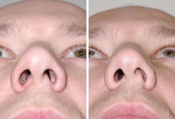 Искривление носовой перегородки – причины, симптомы, лечение 