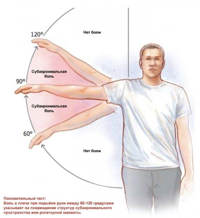 Импинджмент-синдром плечевого сустава (субакромиальный): лечение, причины, симптомы